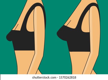 Breast before and after augmentation, beautiful female figure, breast correction with exercises or plastic surgery, vector illustration