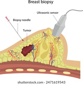 Breast biopsy. Diagnosis of breast disease.