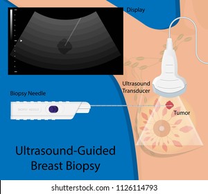 Breast Biopsy Medical Fine Needle Aspiration FNA Diagnostic Lab Laboratory Screening Exam Ultrasound Guided Lump Tumor Cell Tissue Imaging Test Cancerous Core