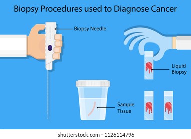 Breast biopsy medical Fine Needle Aspiration FNA diagnostic lab laboratory screening exam Ultrasound Guided lump tumor cell tissue imaging test cancerous core