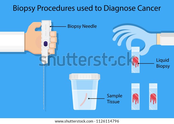 Breast biopsy medical Fine Needle\
Aspiration FNA diagnostic lab laboratory screening exam Ultrasound\
Guided lump tumor cell tissue imaging test cancerous\
core