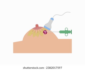 Breast biopsy procedure illustration. Breast cancer diagnostic biopsy for the specimen.