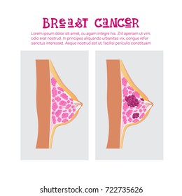 Breast Cancer Awareness Month Pink Ribbon Symbol Flat Vector Illustration