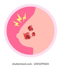 breast cancer cell growth. cancer disease concept