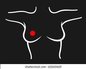 Breast Cancer Diagnosis - Scanning Of Chest Of Woman. Detection Of Lump - Tumor, Carcinoma. Simple Vector Illustration