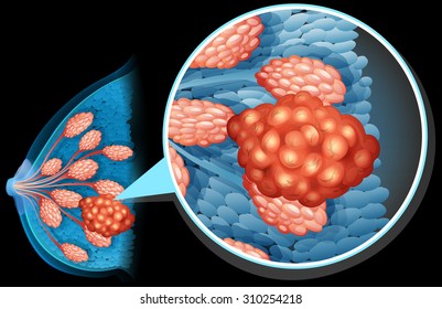 Breast cancer diagram close up illustration