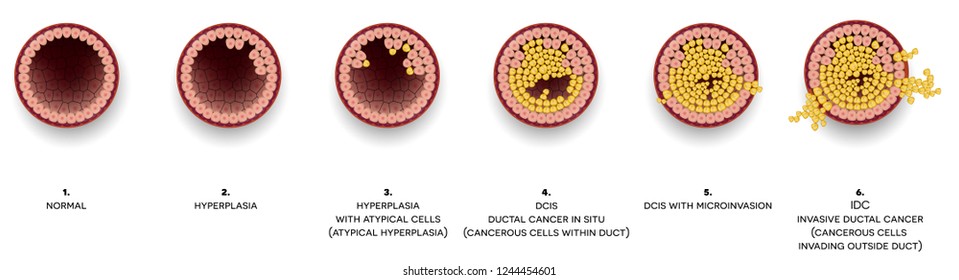 Breast Cancer Ductal Carcinoma Of The Breast. At The Beginning Normal Duct, Then Hyperplasia, After That Atypical Cells Are Invading, Ductal Cancer In Situ And Invasive Ductal Cancer.