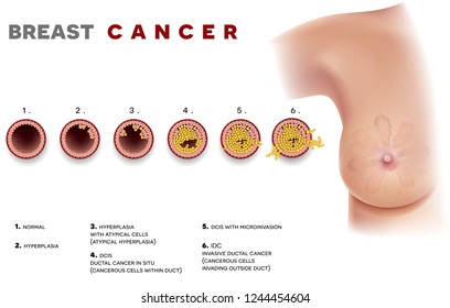 Breast Cancer Ductal Carcinoma Of The Breast. At The Beginning Normal Duct, Then Hyperplasia, After That Atypical Cells Are Invading, Ductal Cancer In Situ And Invasive Ductal Cancer.