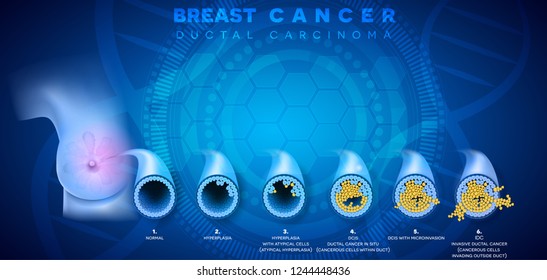 Breast Cancer Ductal Carcinoma Breast Detailed Stock Vector (Royalty ...