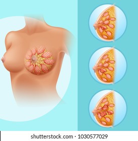 Breast cancer in female human illustration