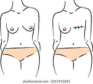 Breast cancer. Female torso. The medicine. Feminism. Vector graphics.