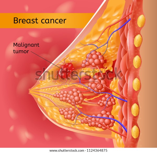 Understanding Breast Cancer Anatomical Chart