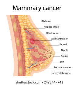 Diagrama del Vector médico del cáncer de mama con una sección transversal de la estructura anatómica de la mama femenina y la ilustración del tumor maligno de mama afectado por el cáncer