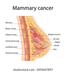 Breast cancer medical vector diagram with a cross-section of female breast anatomical structure and illustration of malignant breast tumor affected by cancer