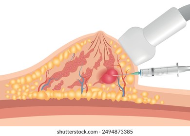 Breast cancer medical vector diagram with a cross-section of female breast anatomical structure and illustration of malignant breast tumor affected by cancer