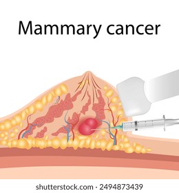 Breast cancer medical vector diagram with a cross-section of female breast anatomical structure and illustration of malignant breast tumor affected by cancer