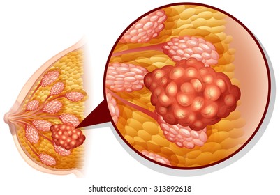 Breast cancer on white illustration