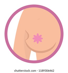 Breast cancer sign