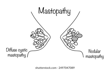 Breast disease of non-inflammatory origin. It is characterized by a change in the ratio in the structure of the gland between epithelial and connective tissues. Two main types of mastopathy are drawn.