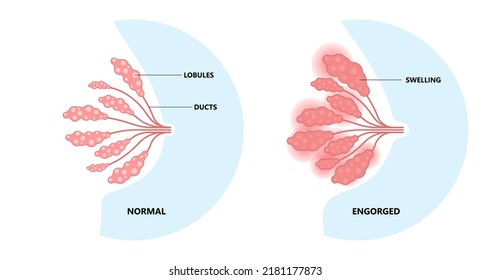 Breast Engorged Blocked Mass Milk Ducts Swollen Breastfeed