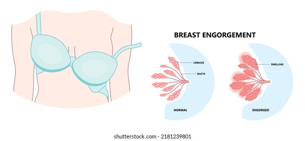 Breast Engorged Blocked Mass Milk Ducts Swollen Breastfeed