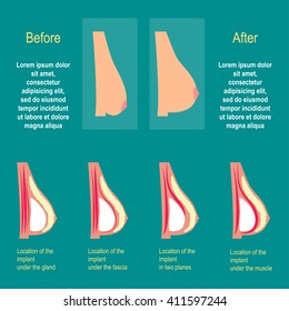 The breast enlargement. The installation of implants. Plastic surgery breast
The methods of installation of the implants in the chest. The result of plastic surgery. Vector illustration. Flat design