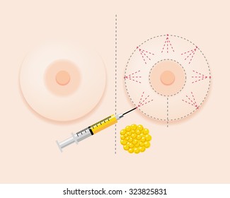 Breast Fatgraft Surgery Image With Injection And Extracted Fat