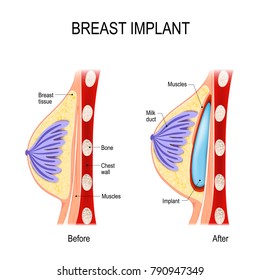 Breast Implant. Cosmetic (plastic) surgery. method of the Submuscular Pocket (under the muscle). This method is used in women who have minimal breast tissue