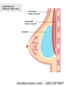 Breast Implant In Female Silhouette, Subfascial Placement. Bust Enhancement Operation, Woman Chest After Plastic Surgery. Infographic Poster For Clinic. Anatomical Isolated Flat Vector Illustration.