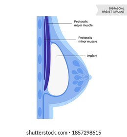 Breast Implant In Female Silhouette, Subfascial Placement. Bust Enhancement Operation, Woman Chest After Plastic Surgery. Infographic Poster For Clinic. Anatomical Isolated Flat Vector Illustration.