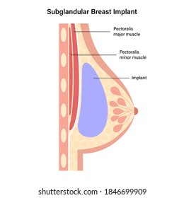 Breast Implant In Female Silhouette, Subglandular Placement. Bust Enhancement Operation, Woman Chest After Plastic Surgery. Infographic Poster For Clinic. Anatomical Isolated Flat Vector Illustration.