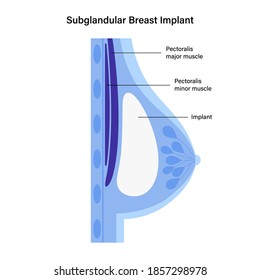 Breast Implant In Female Silhouette, Subglandular Placement. Bust Enhancement Operation, Woman Chest After Plastic Surgery. Infographic Poster For Clinic. Anatomical Isolated Flat Vector Illustration.