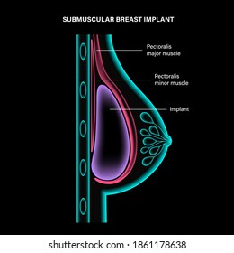 Breast implant in female silhouette, submuscular placement. 3d realistic infographic poster, x ray scanning. Bust enhancement operation, woman chest after plastic surgery. Isolated vector illustration