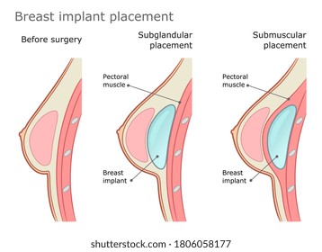 Breast implant placement diagram. Subglandular and submuscular placement types. Plastic surgery of breast implants.