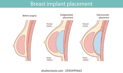 Breast implant placement diagram. Subglandular and submuscular types of placement. Medical illustration plastic surgery of breast implants.