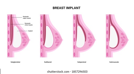 Breast Implant Types In Female Silhouette. Subglandular, Subfascial, Subpectoral, Submuscular Placement. Bust Enhancement Result, Woman Chest After Plastic Surgery. Flat Anatomical Vector Illustration