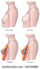 Breast implants - with and without implants - vector illustration