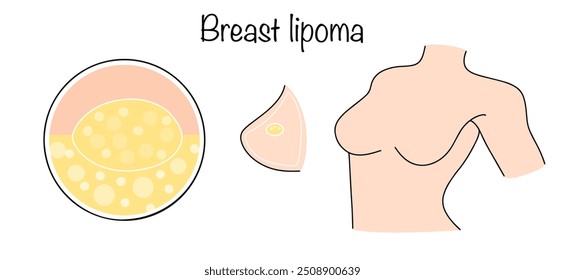 Breast lipoma. A benign tumor that develops from mature fat cells. A woman with a lipoma inside the breast. Vector illustration.