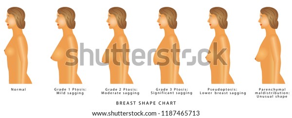 Breast Shape And Size Chart