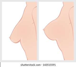 Breast Uplift before and after treatment. Vector illustration.