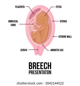 breech baby position in uterus during pregnancy. Colored medical vector diagram with terms. Fetus with umbilical cord and placenta