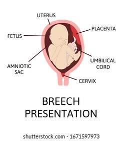 what does breech presentation mean in pregnancy