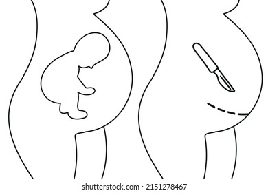 Breech presentation. Fetal baby positions in the uterus during pregnancy. Cesarean section flat icon. Scalpel near belly. Surgical operation for childbirth.