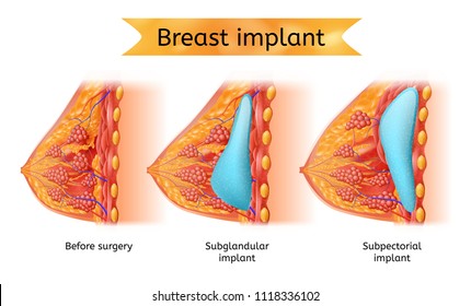 Brest Implant Vector Medical Scheme with Womans Breast Before and After Operation, Implant Placement Anatomy, Cross Section View Illustration. Female Brest Augmentation with Plastic Surgery Procedure