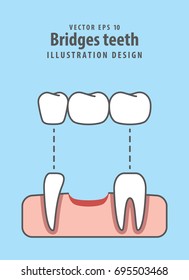 Bridges teeth illustration vector on blue background. Dental concept.