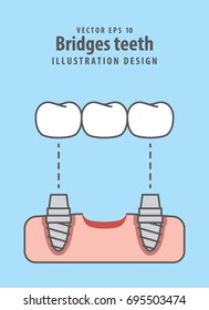 Bridges teeth illustration vector on blue background. Dental concept.