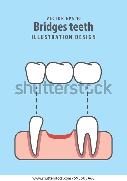 Bridges teeth illustration vector on blue\
background. Dental\
concept.