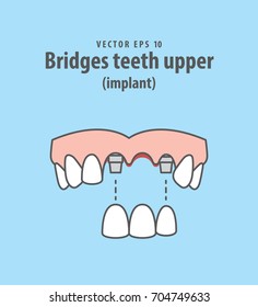 Bridges teeth upper (implant) illustration vector on blue background. Dental concept.