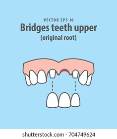 Bridges teeth upper (original root) illustration vector on blue background. Dental concept.