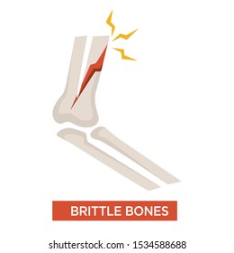 Brittle Bones Health Issue Concept With Bone Fracture, Aging Body Changes, Osteoporosis Health Issue, Medical Condition, Isolated Colorful Flat Vector Illustration On White Background And Text